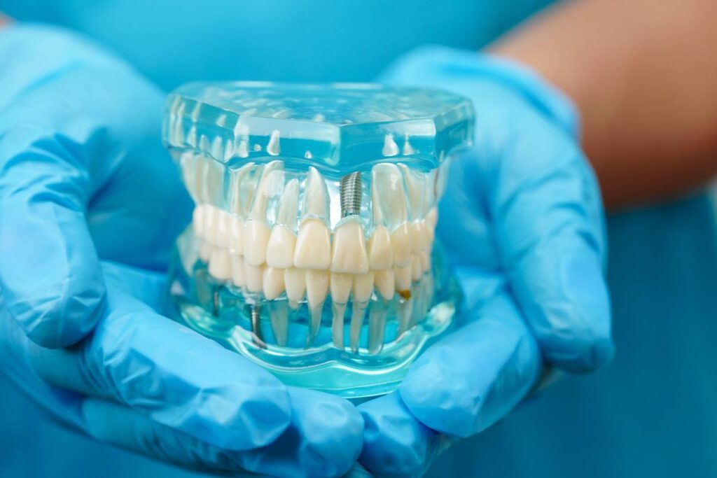 A clear dental model of a full set of teeth with three metal dental implants.