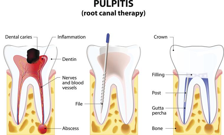 Root canal therapy illustration