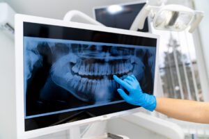 Dentist wearing gloves pointing to a dental X-ray image in a dental office